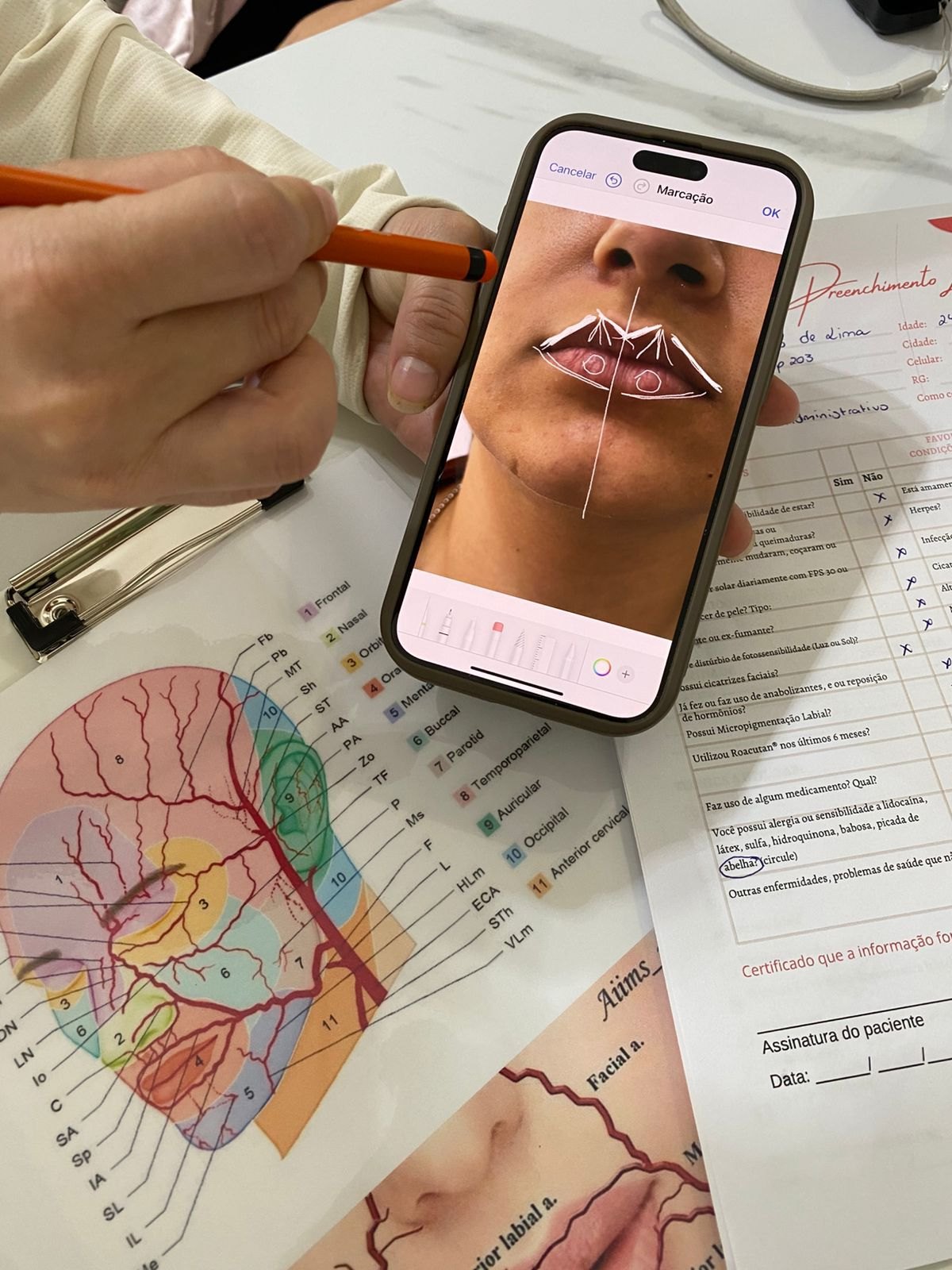Planejamento do preenchimento labial sobre a foto da paciente, ao lado da ficha de anamnese