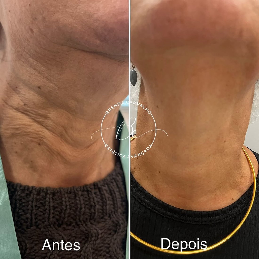 Rejuvenescimento de pescoço e colo