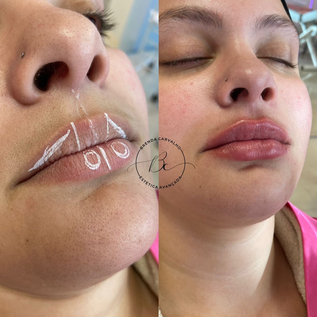 Preenchimento labial, da marcação ao resultado