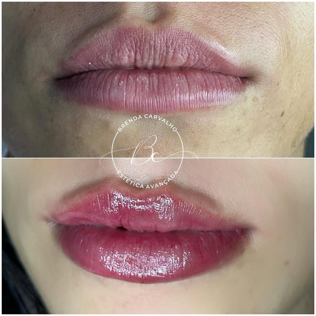 Preenchimento e definição de contorno labial